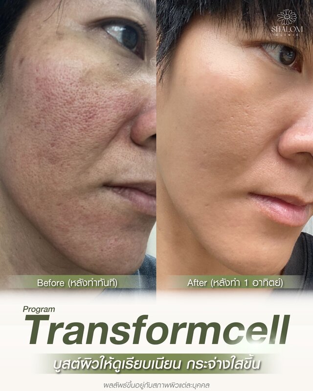 Transformcell Treatment